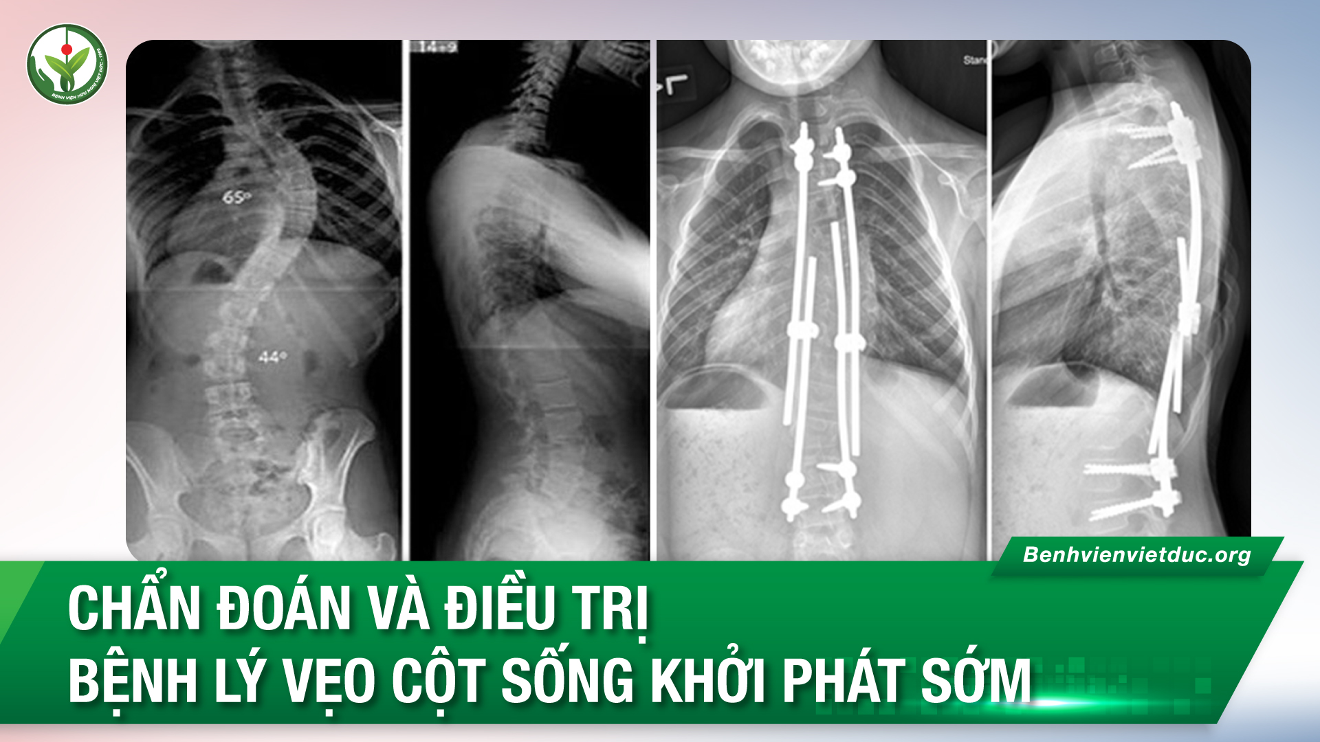 Phát hiện và phòng tránh Vẹo Cột Sống ở giai đoạn đầu